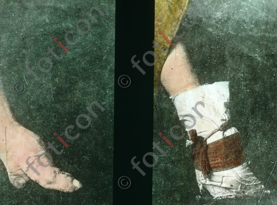 Verkrüppelte Füße ; Crippled foot (simon-173a-038.jpg)